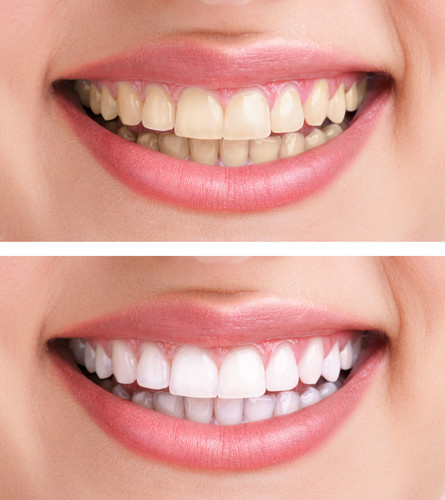 Teeth Whitening at Cadena Family Dentistry
