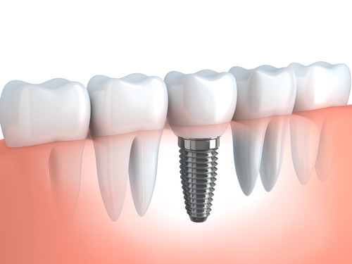 Dental Implants at Cadena Family Dentistry