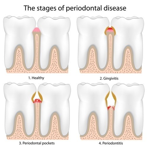 Gum Disease Treatment at Cadena Family Dentistry