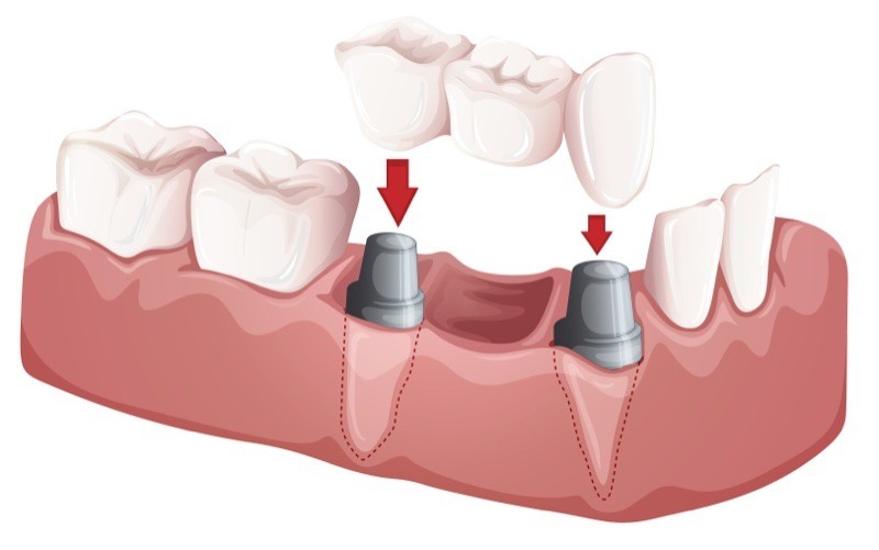 Porcelain Bridges at Cadena Family Dentistry