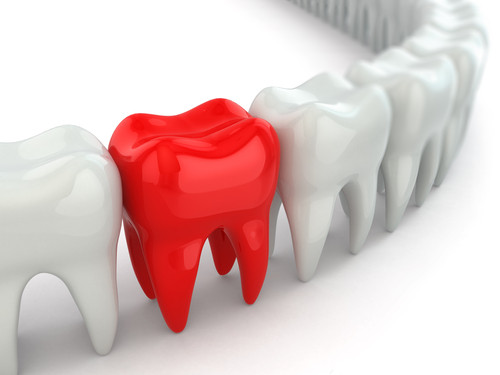 Preventive Resin Restorations at Cadena Family Dentistry