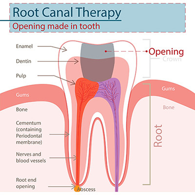 Root Canal Therapy at Cadena Family Dentistry