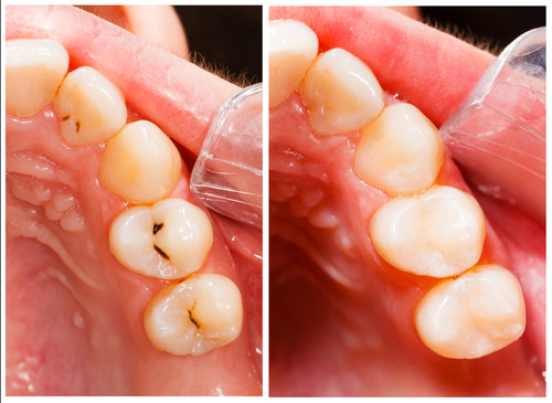 Tooth-Colored Fillings at Cadena Family Dentistry