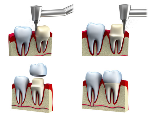 Porcelain Crowns at Cadena Family Dentistry